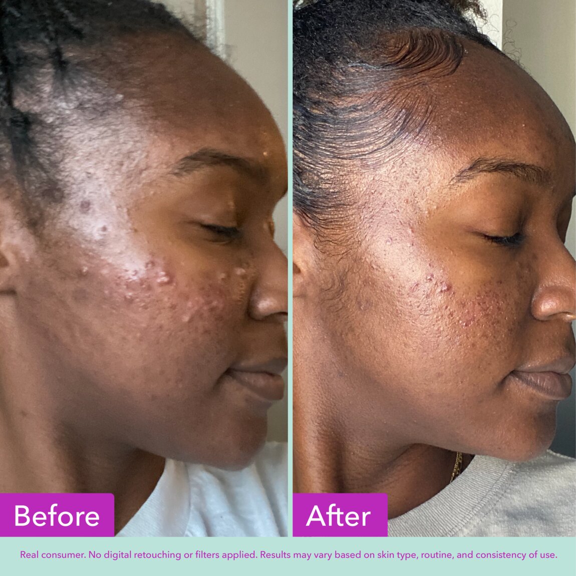 acne-foaming-cleanser-o3 zb_p.jpg